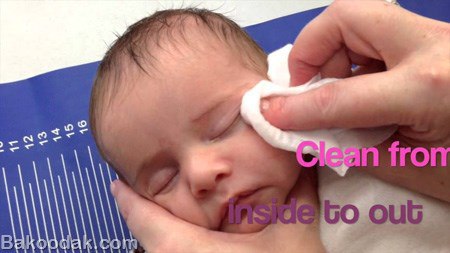 مجرای اشکی مسدود شده در نوزادان