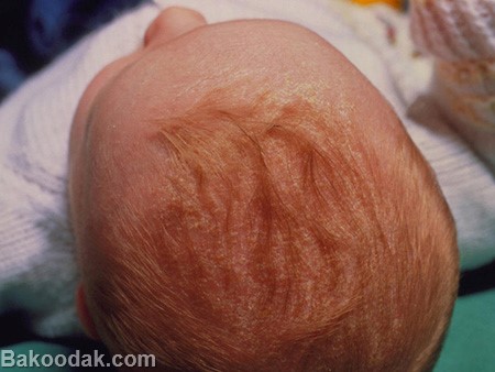 پوست پوست شدن سر نوزاد،دلایل و درمان